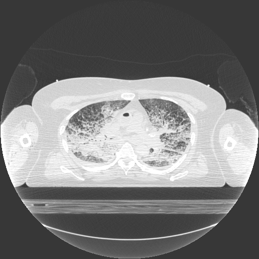Axial chest CT from the demo study, displayed in a lung window